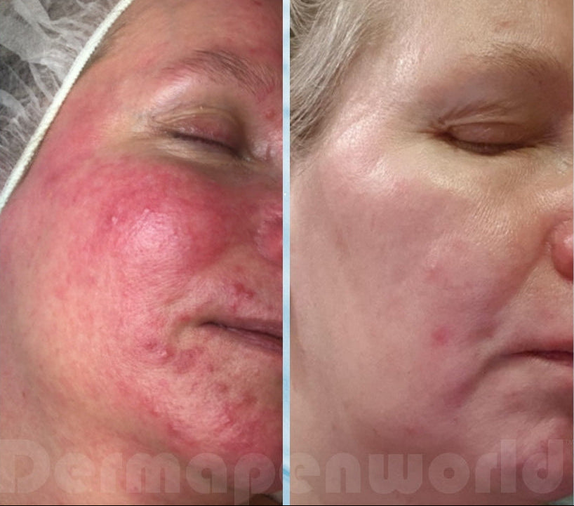 Dermapen-before-after-acne