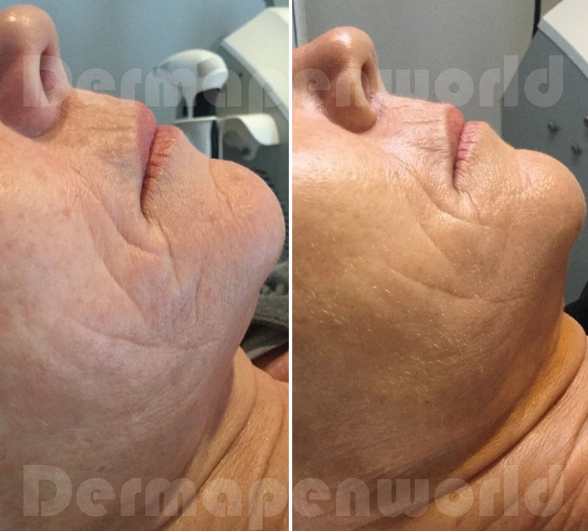 Dermapen Before and After